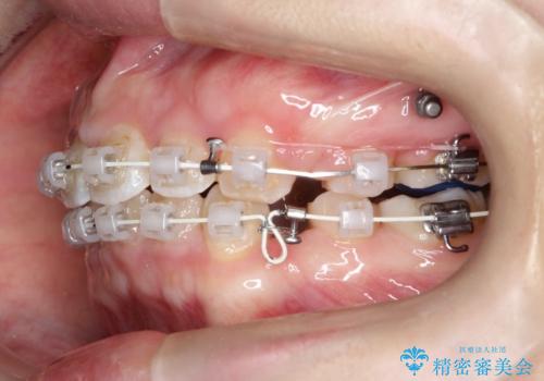 【抜歯矯正】口元を下げたい!の治療中