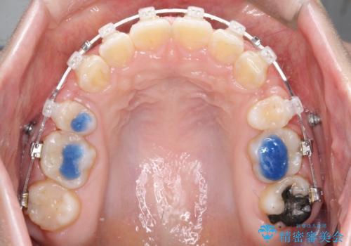 【抜歯矯正】口元を下げたい!の治療中