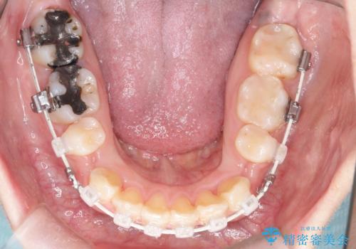 【抜歯矯正】口元を下げたい!の治療中