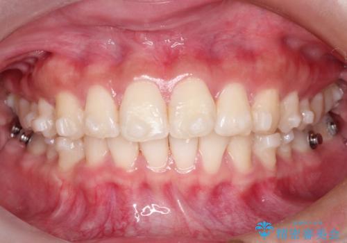 【インビザライン】翼状捻転+出っ歯を治したいの治療中