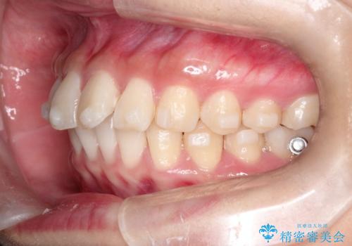 【インビザライン】翼状捻転+出っ歯を治したいの治療中