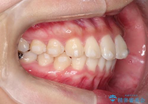 【インビザライン】翼状捻転+出っ歯を治したいの治療中