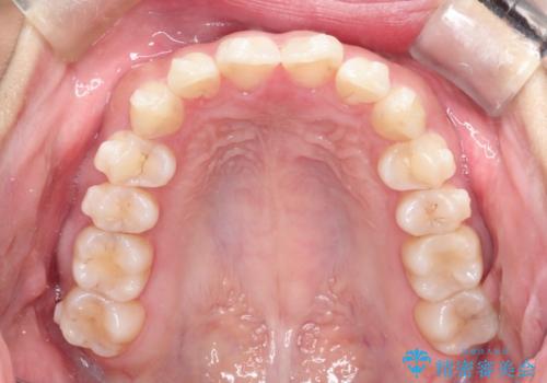 【インビザライン】翼状捻転+出っ歯を治したいの治療中