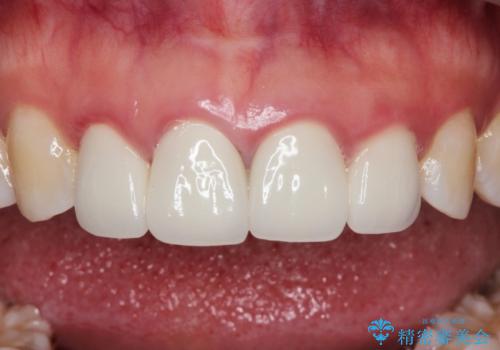 【精密根管治療+オールセラミッククラウン】より自然な前歯にしたい!の治療前