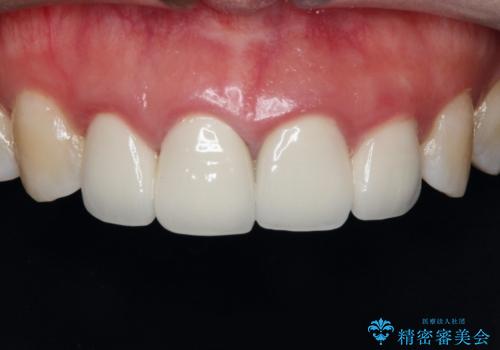 【精密根管治療+オールセラミッククラウン】より自然な前歯にしたい!の治療前