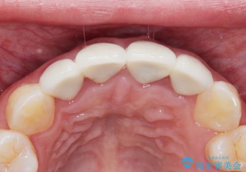 【精密根管治療+オールセラミッククラウン】より自然な前歯にしたい!の治療前