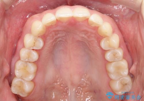 【インビザライン】翼状捻転+出っ歯を治したいの治療後