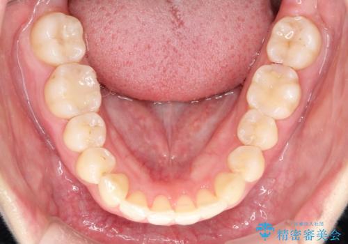 【インビザライン】翼状捻転+出っ歯を治したいの治療後