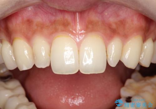 【オールセラミッククラウン】矮小歯の治療の治療前