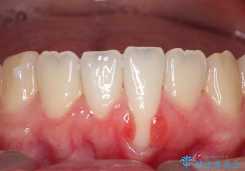 【根面被覆】結合組織移植により下がった歯肉を再生の症例 治療前