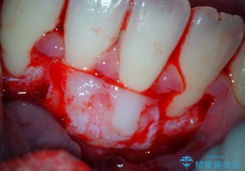【根面被覆】結合組織移植により下がった歯肉を再生の治療中