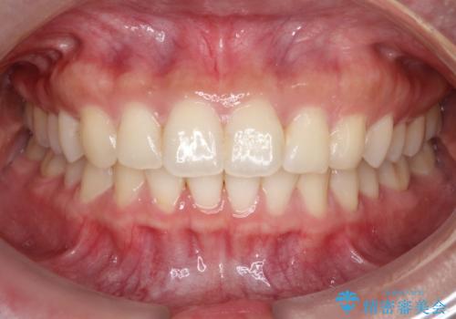 【インビザライン】翼状捻転+出っ歯を治したいの治療後