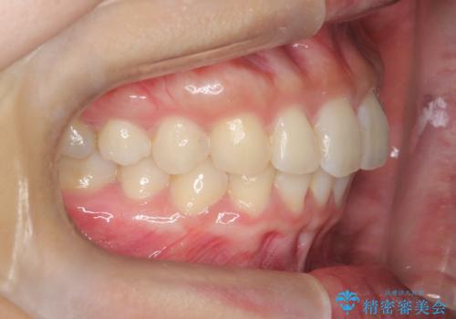 【インビザライン】翼状捻転+出っ歯を治したいの治療後
