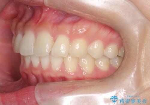 【インビザライン】翼状捻転+出っ歯を治したいの治療後