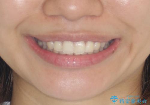 【インビザライン】翼状捻転+出っ歯を治したいの治療後