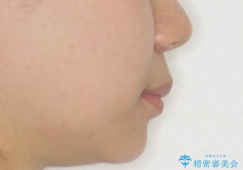 【インビザライン】翼状捻転+出っ歯を治したいの治療後