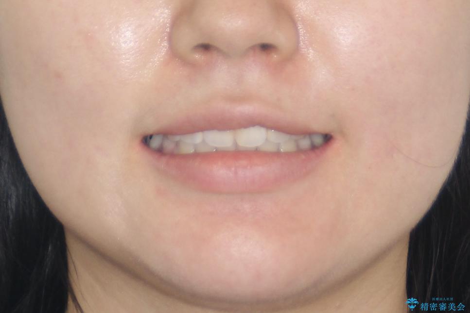 【抜歯矯正】口元を下げたい!の治療後(顔貌)