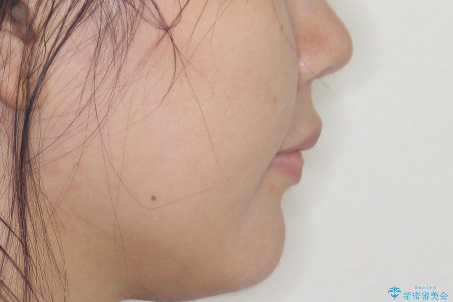 【抜歯矯正】口元を下げたい!の治療後(顔貌)