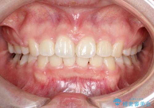 【抜歯矯正】口元を下げたい!の治療後