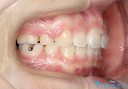 【抜歯矯正】口元を下げたい!の治療後