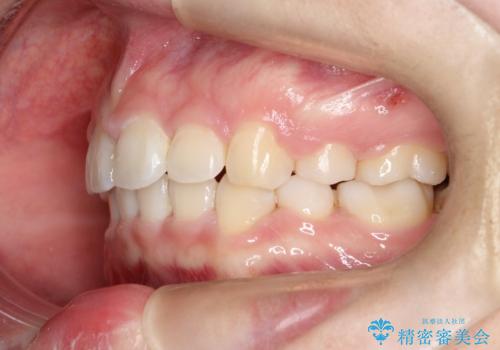 【抜歯矯正】口元を下げたい!の治療後