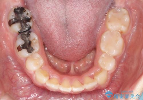 【抜歯矯正】口元を下げたい!の治療後