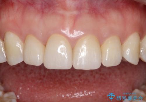 【精密根管治療+オールセラミッククラウン】より自然な前歯にしたい!の治療後