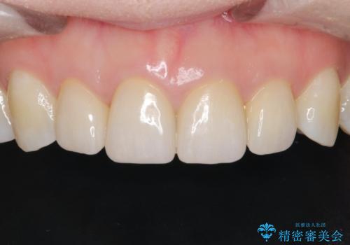 【精密根管治療+オールセラミッククラウン】より自然な前歯にしたい!の治療後