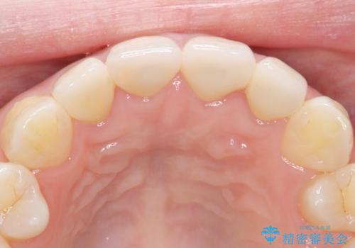 【精密根管治療+オールセラミッククラウン】より自然な前歯にしたい!の治療後
