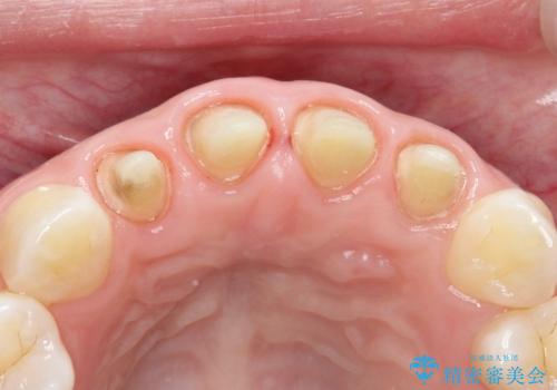 【精密根管治療+オールセラミッククラウン】より自然な前歯にしたい!の治療中