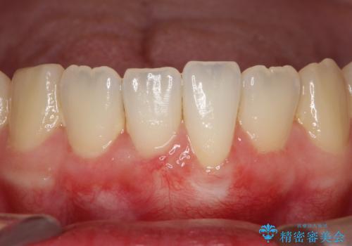 【根面被覆】結合組織移植により下がった歯肉を再生の治療後