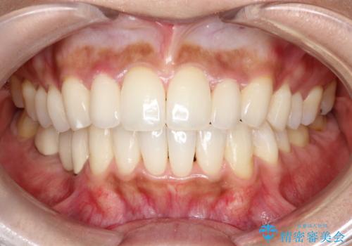 【オールセラミッククラウン】矮小歯の治療の症例 治療後