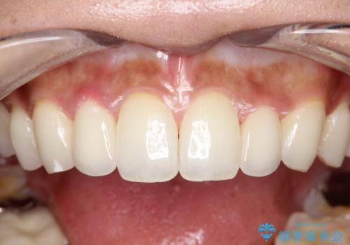 【オールセラミッククラウン】矮小歯の治療の治療後