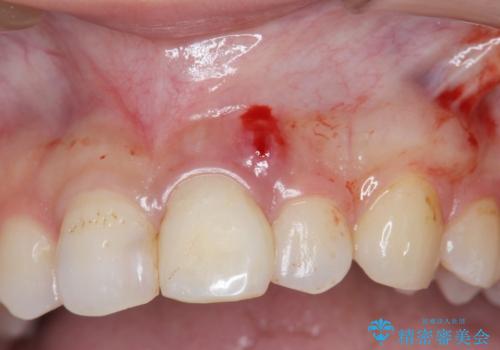 前歯のブリッジ治療の治療中