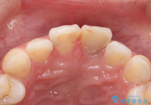 前歯のブリッジ治療の治療前