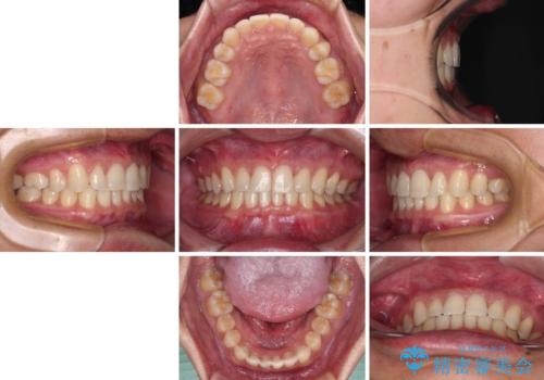 著しいディープバイトと隙間だらけの歯列 の治療後