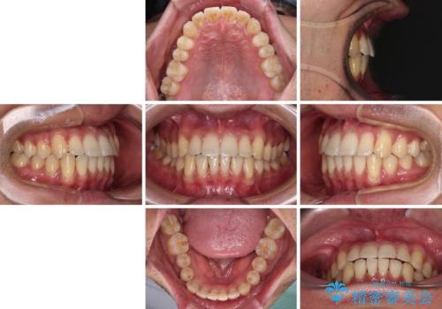 ワイヤー装置での上下前歯の部分矯正の治療後