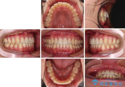 軽微なデコボコを安価に インビザライン・ライトによる矯正治療の治療後