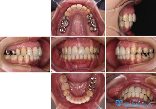 内側に倒れた前歯と口元の突出感 ワイヤー装置での抜歯矯正の治療後