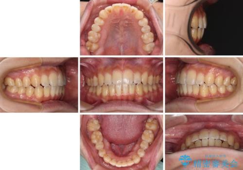 オープンバイトと目立つ銀歯 インビザライン矯正とセラミック修復治療の治療後