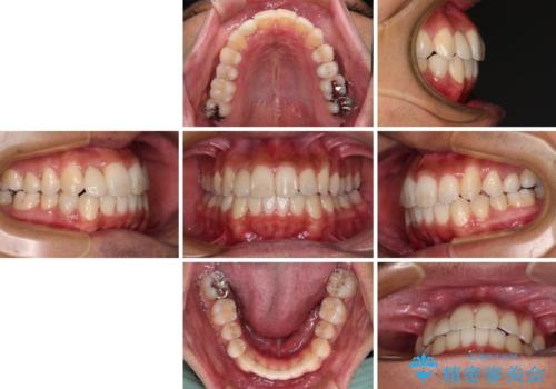 【モニター】左右のクロスバイトをインビザラインできれいに改善の治療後