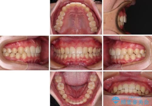 【モニター】斜めに突き出した前歯をインビザラインで改善の治療後