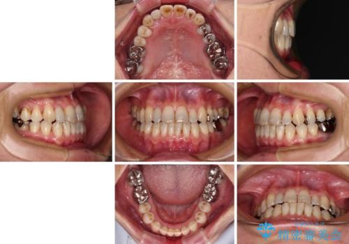 急速拡大装置　前歯の反対咬合をインビザラインで改善の治療後