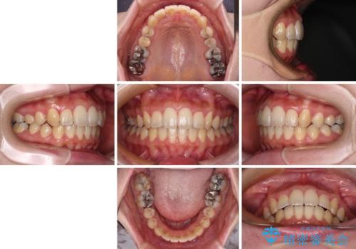 捻れた前歯をインビザラインでスッキリとの治療後