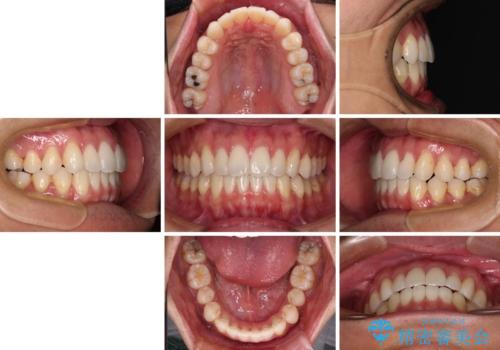 少しでも口元を閉じやすく インビザラインによる前突の解消の治療後