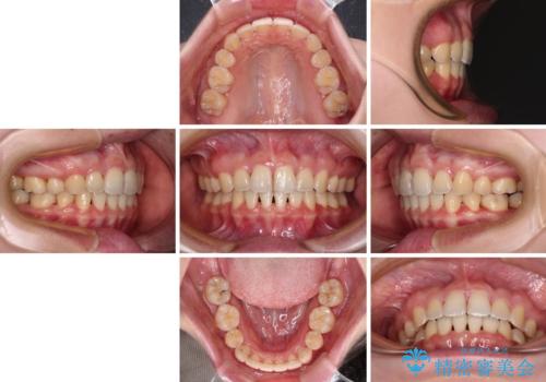 【モニター】短期間で口の閉じにくさを改善 ワイヤー装置での抜歯矯正の治療後