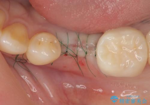 乳歯がぐらついてきた インプラントを用いた機能回復の治療中