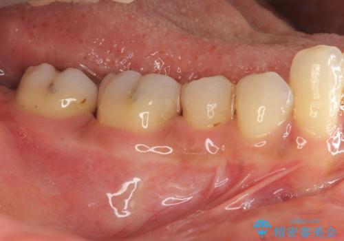 [ 歯周病 ]　歯を残す再生治療の症例 治療後