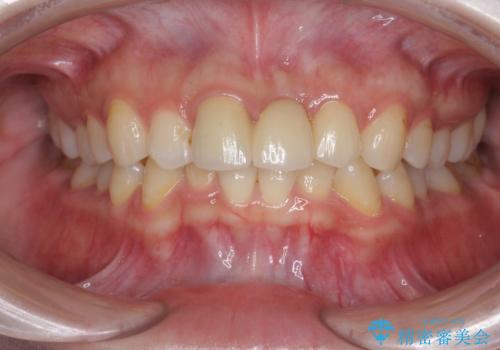 前歯のブリッジ治療の治療後