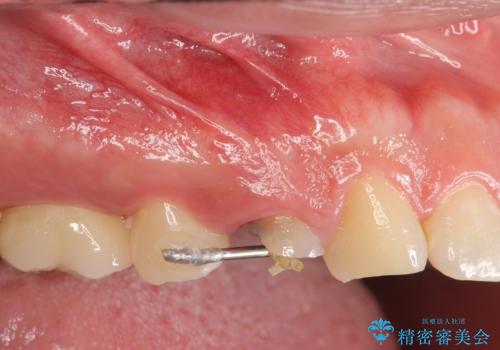 保険治療では抜歯適応になる歯 抜歯せずに保存(エクストリュージョン)の治療中